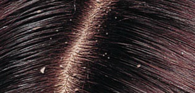 ما تفسير نزع القملة من الشعر في المنام للعزباء لابن سيرين؟