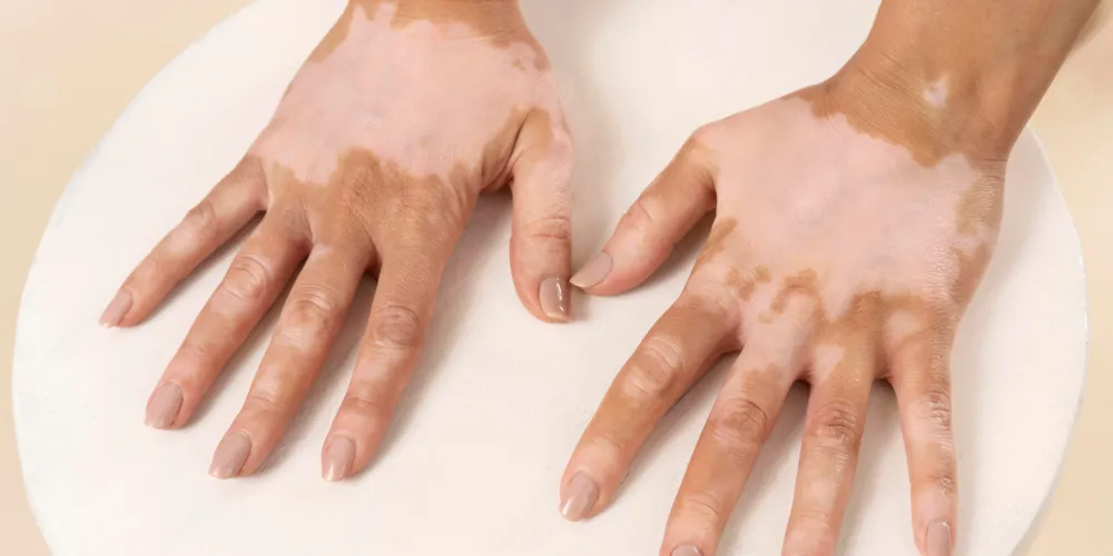 ما تفسيرات ابن سيرين لرؤية البهاق في الوجه في المنام؟