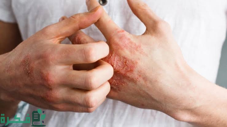 ما تفسير رؤية ابن سيرين التقرحات في المنام؟