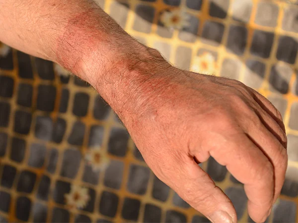 ما تفسير رؤية الجسم المحروق في المنام لابن سيرين؟