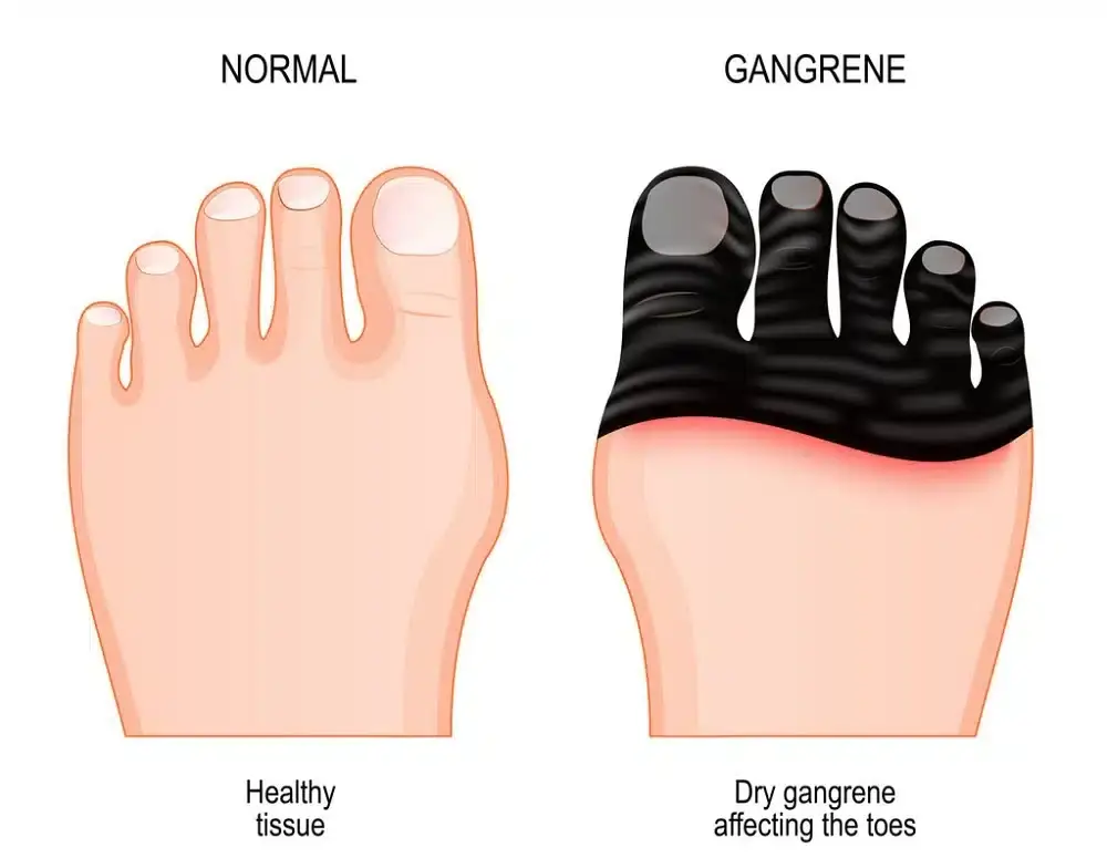 ما تفسير رؤية الغرغرينا في الإصبع في المنام لابن سيرين؟